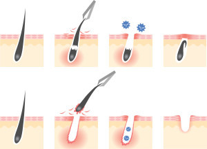 毛抜きは肌トラブルの原因に？