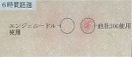 エンジェニードルと他社注射針の比較 6時間後