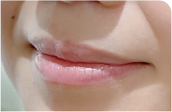 フルリップ Before