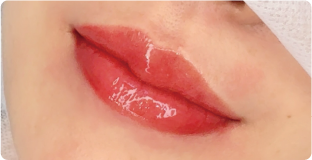 フルリップ施術例
