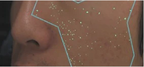 照射後の女性の顔