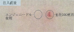 エンジェニードルと他社注射針の比較 注入直後